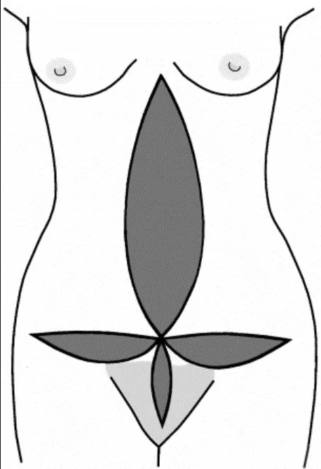 fleur de lis abdominoplasty technique