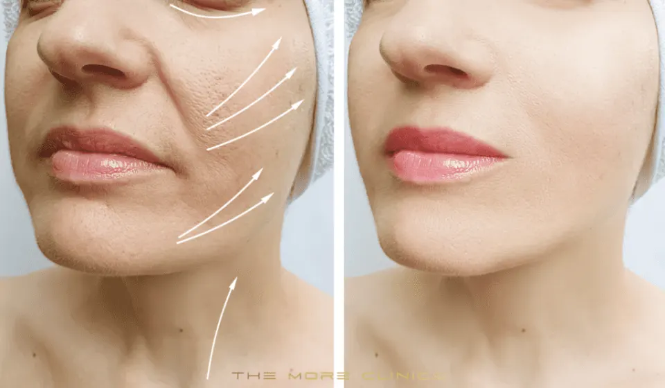 Facelift Turkey before and after — deep plane, SMAS and mini facelift complete cost guide 2026