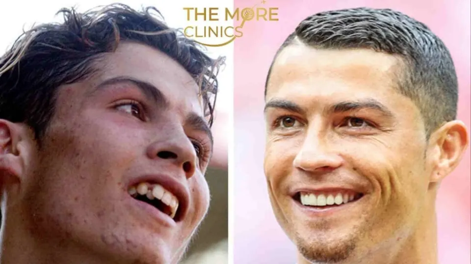 cristiano ronaldo teeth before and after